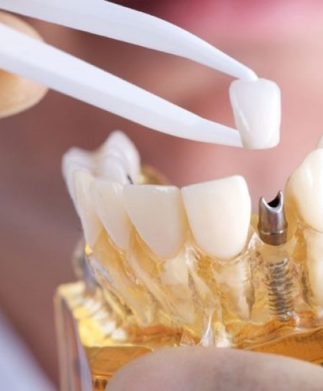 tratamento-de-implantes-dentarios