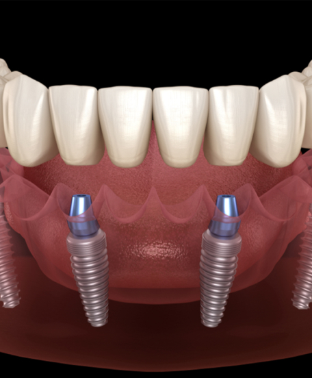 proteses-dentarias-consultorio-odontologico-em-citoria-es