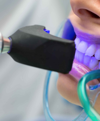 Clareamento Dental à Laser| Consultório Odontológico em Vitória – ES