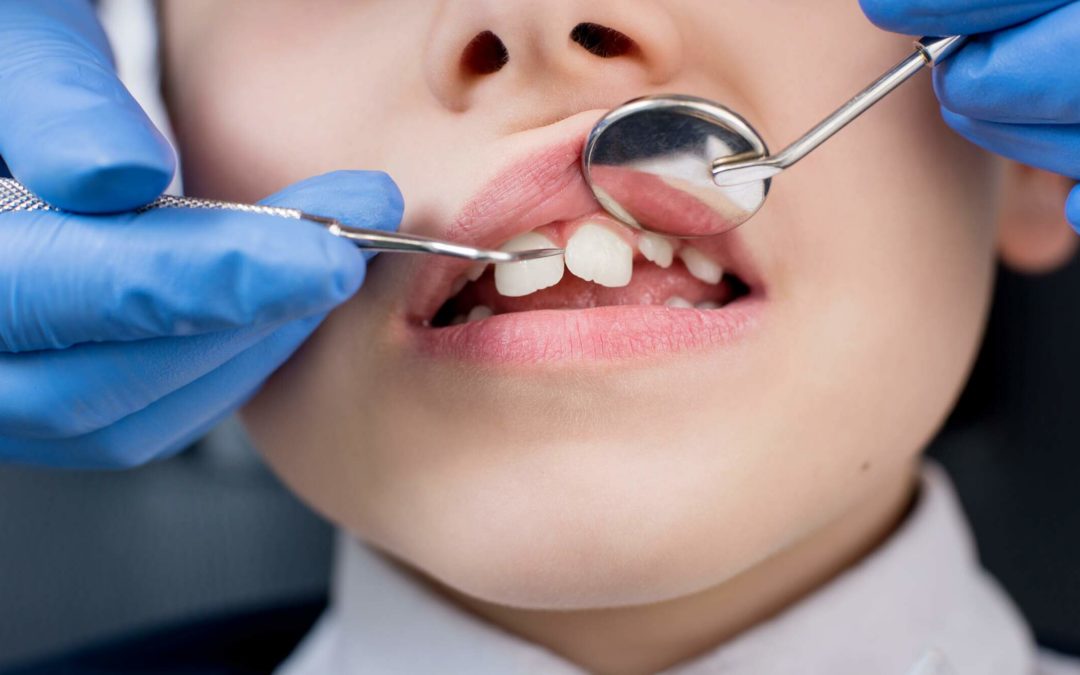 Aparelhos dentários | Sinais de que você precisa usar