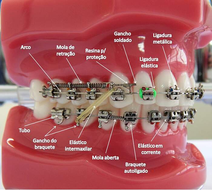 Como funciona a montagem de aparelho ortodôntico?