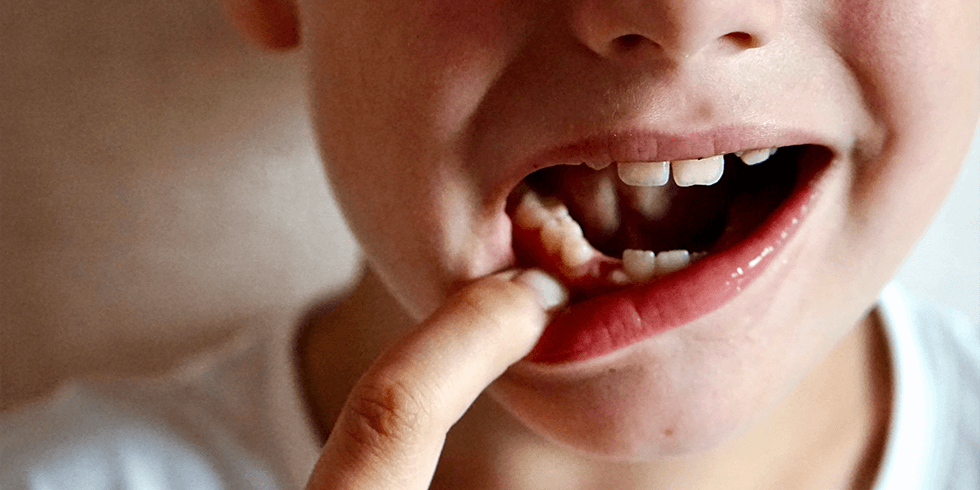 Dentes Permanentes Demorando a Nascer. É Normal?