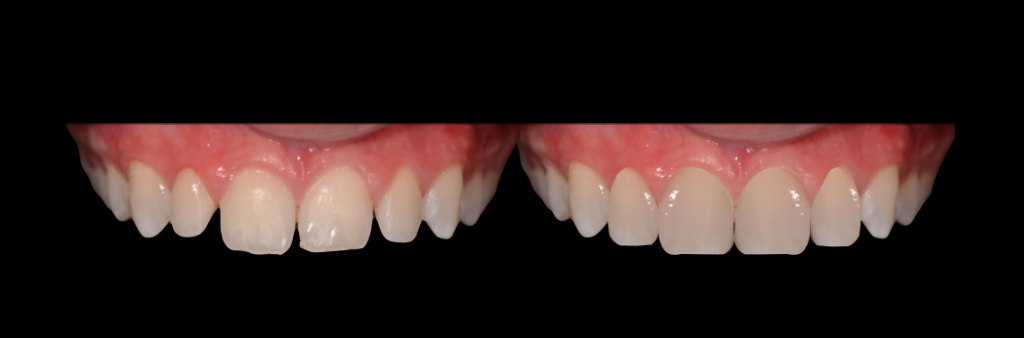 desenho-digital-do-futuro-sorriso-apos-ortodontia