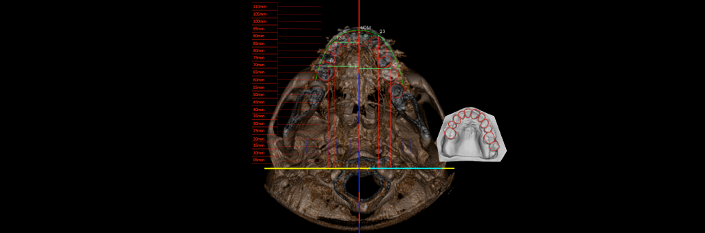 localizacao-de-implantes-e-guia-do-sorriso