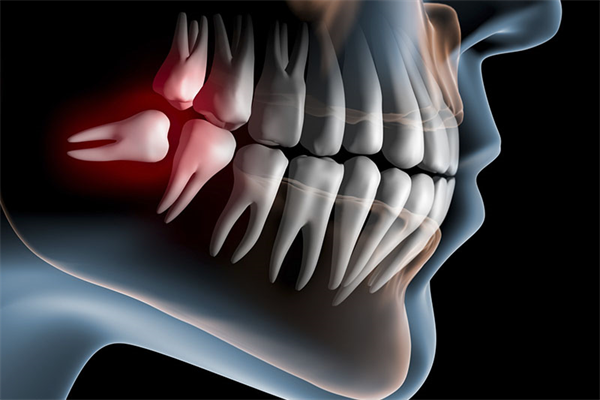 Nascimento do siso | Mitos e verdades sobre o surgimento desses dentes