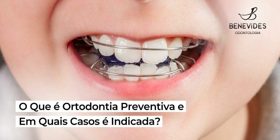 Ortodontia Preventiva: Conheça as Indicações e Seus Benefícios