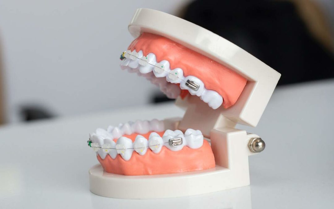 Traumas Dentários Impedem Os Tratamentos Ortodônticos? Entenda.