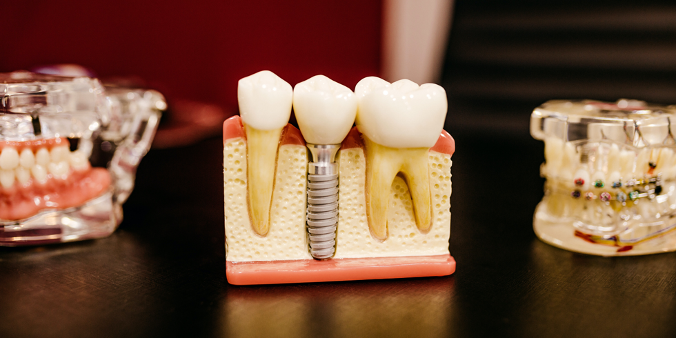 Implante dental | Como funciona?