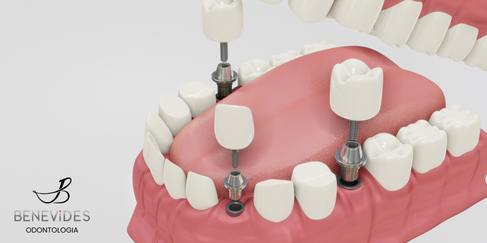 Coroas Dentárias: O Sorriso Perfeito Ao Seu Alcance