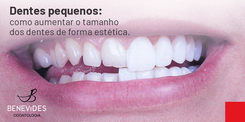 Dentes Pequenos: Como Aumentar o Tamanho Dos Dentes de Forma Estética.