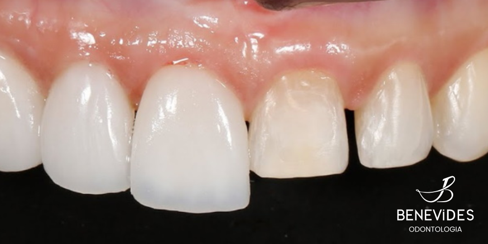 Dentes Pequenos: Como Aumentar o Tamanho Dos Dentes de Forma Estética.