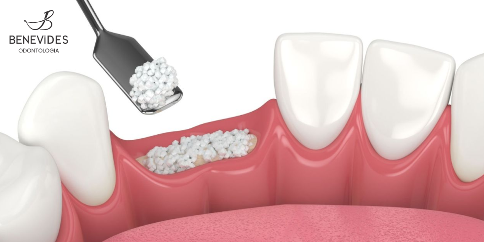 Enxerto ósseo dentário: tire todas as suas dúvidas