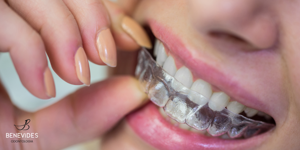 Tratamentos Modernos De Ortodontia Para Um Sorriso Perfeito