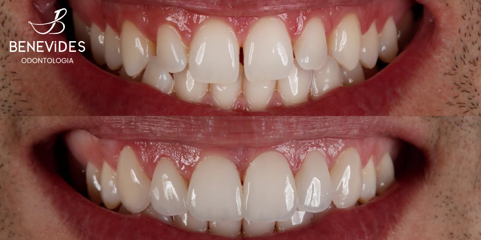 Dentes Pequenos: Como Aumentar o Tamanho Dos Dentes de Forma Estética.