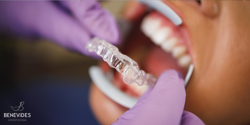 Invisalign: Transformando Sorrisos com Tecnologia Inovadora