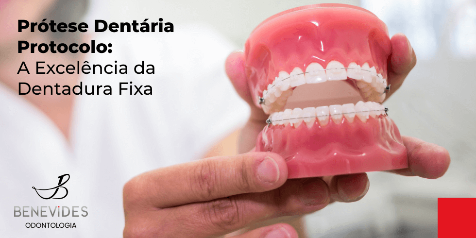 Prótese Dentária Protocolo: A Excelência da Dentadura Fixa