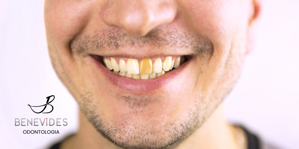 Perda de Esmalte do Dente: Tem Tratamento?
