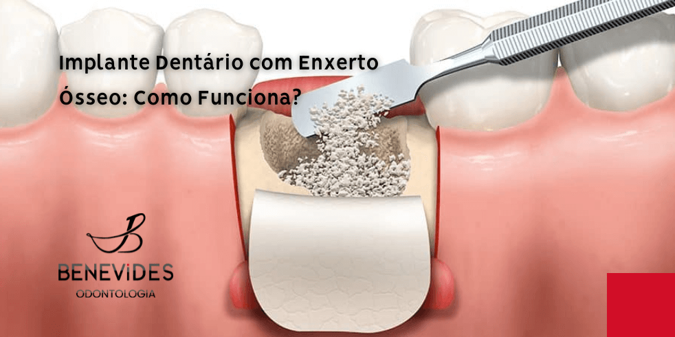 Implante Dentário com Enxerto Ósseo: Como Funciona?