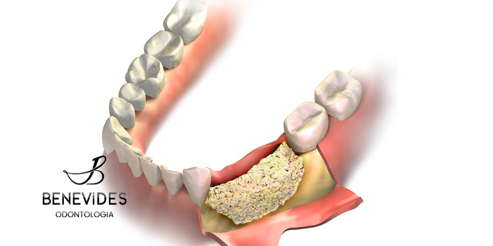 Implante Dentário com Enxerto Ósseo: Como Funciona?
