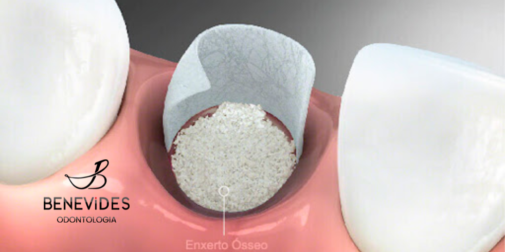 Implante Dentário com Enxerto Ósseo: Como Funciona?
