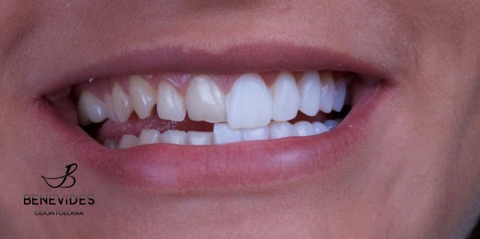 Lentes de Contato Dentais: Veja os Benefícios Desse Procedimento
