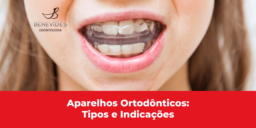 Aparelhos Ortodônticos: Tipos e Indicações