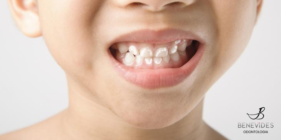 Manchas nos Dentes: Quais as Principais Causas

