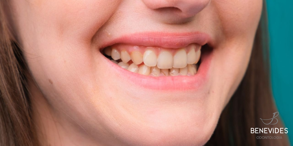 Manchas nos Dentes: Quais as Principais Causas

