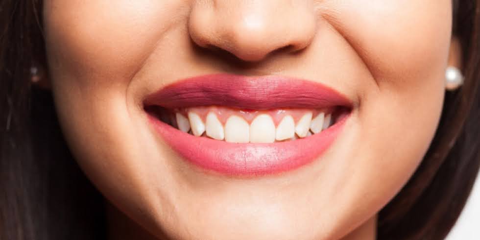 Sorriso Gengival: Como a Harmonização Pode Corrigir Esse Incômodo Estético
