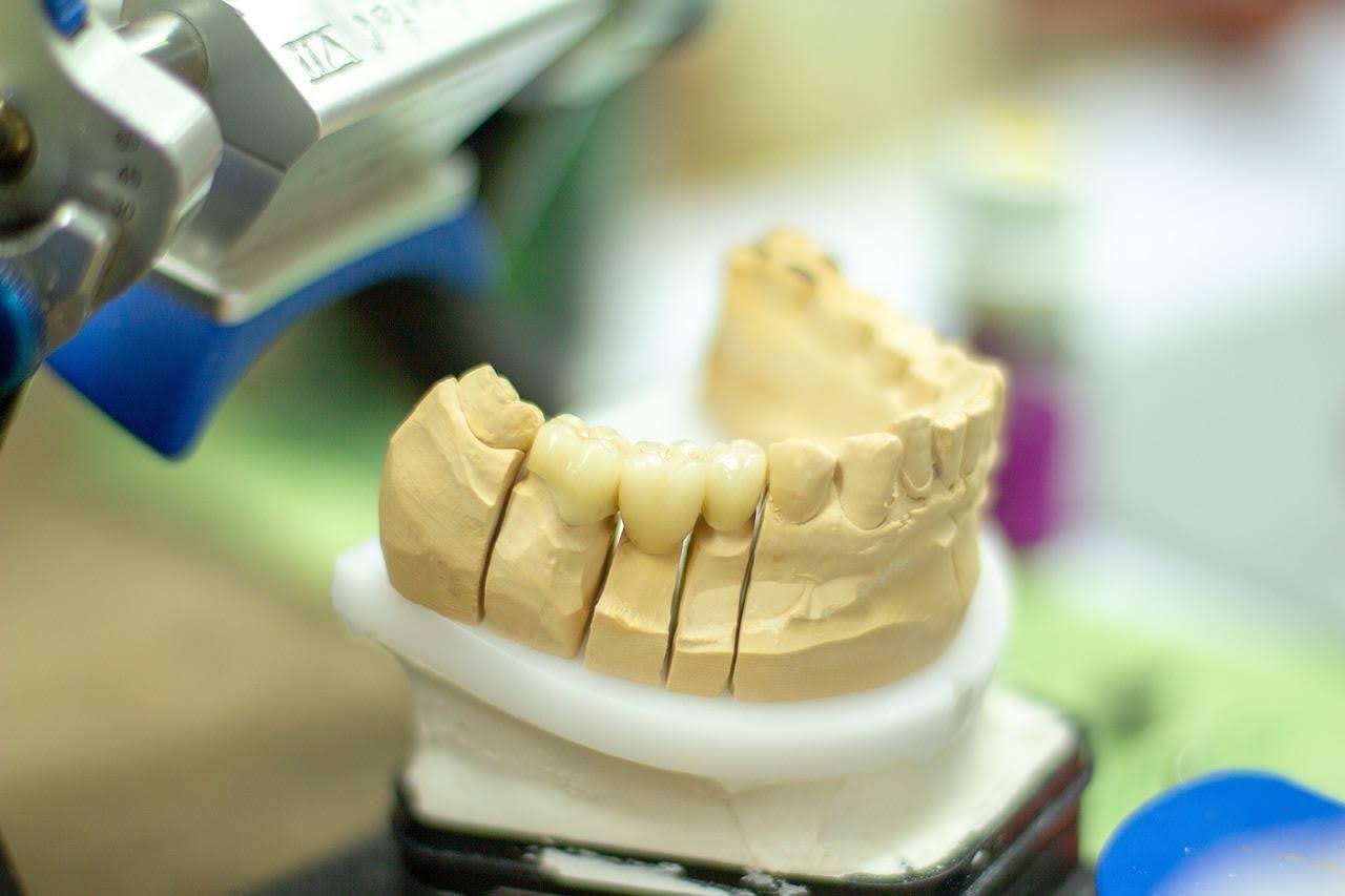 Reposição de Dentes Perdidos: Qual o Melhor Tratamento Para Cada Caso? 
