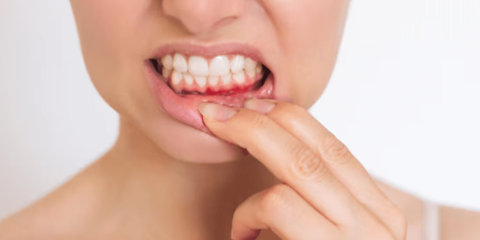 O que o Sangramento Gengival pode Indicar sobre sua Saúde Bucal