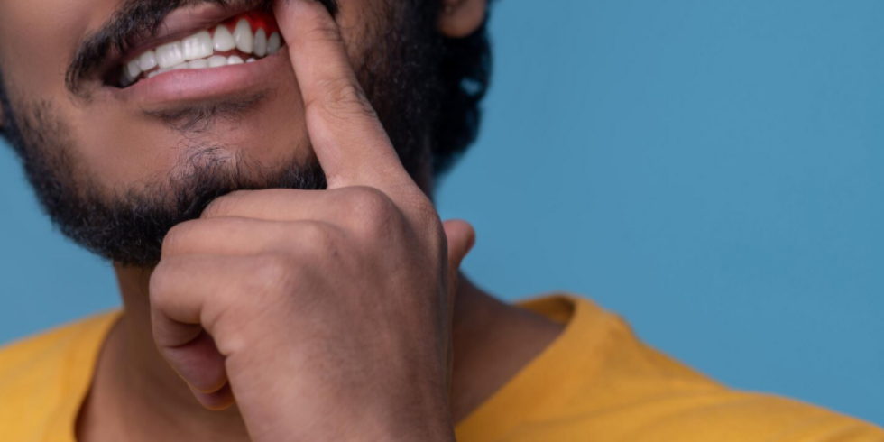 O que o Sangramento Gengival pode Indicar sobre sua Saúde Bucal | Dr. Jefferson Benevides Ortodontia e Ortopedia Facial no ES O que o Sangramento Gengival pode Indicar sobre sua Saúde Bucal