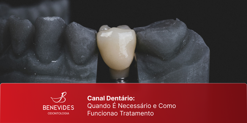 Canal Dentário: Quando É Necessário e Como Funciona o Tratamento