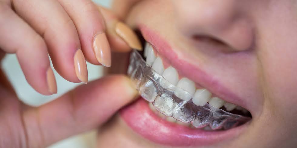 Aparelho Fixo vs. Aparelho Móvel: Qual é o Melhor para Você? | Dr. Jefferson Benevides Ortodontia e Ortopedia Facial no ES As vantagens de cada aparelho para o tratamento dental
