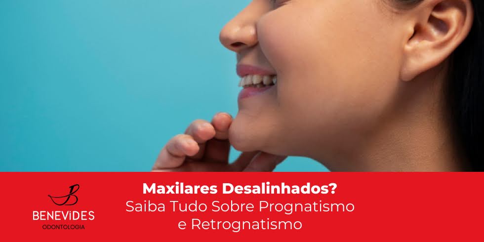 Maxilares Desalinhados? Saiba Tudo Sobre Prognatismo e Retrognatismo