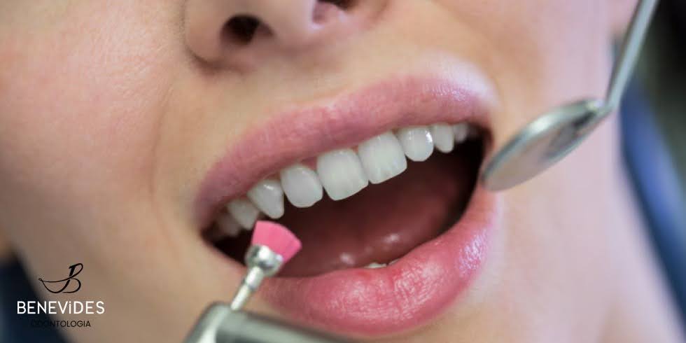 Limpeza dental: de quanto em quanto tempo fazer? | Dr. Jefferson Benevides Ortodontia e Ortopedia Facial no ES Limpeza dental: de quanto em quanto tempo fazer? | Dr. Jefferson Benevides Ortodontia e Ortopedia Facial no ES